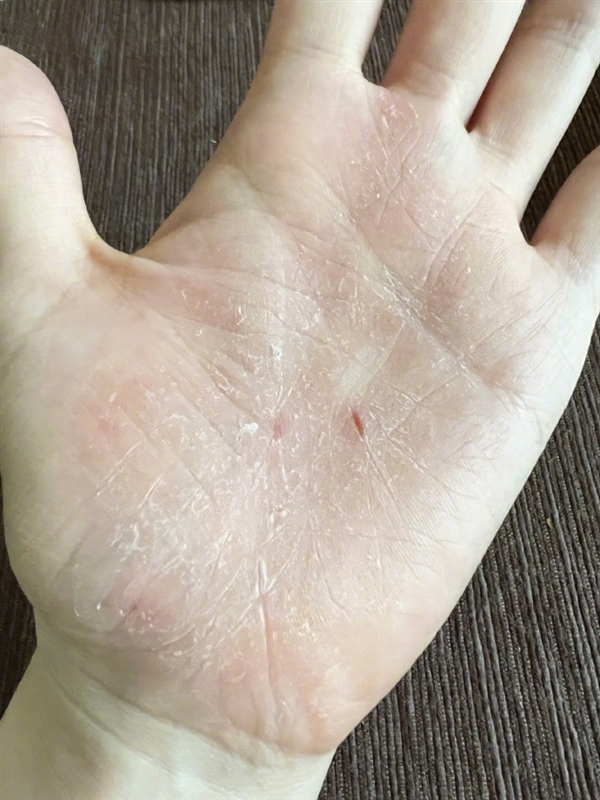 张靓颖自曝体检查出营养不良:额头血管莫名突起 伸懒腰手掌就流血