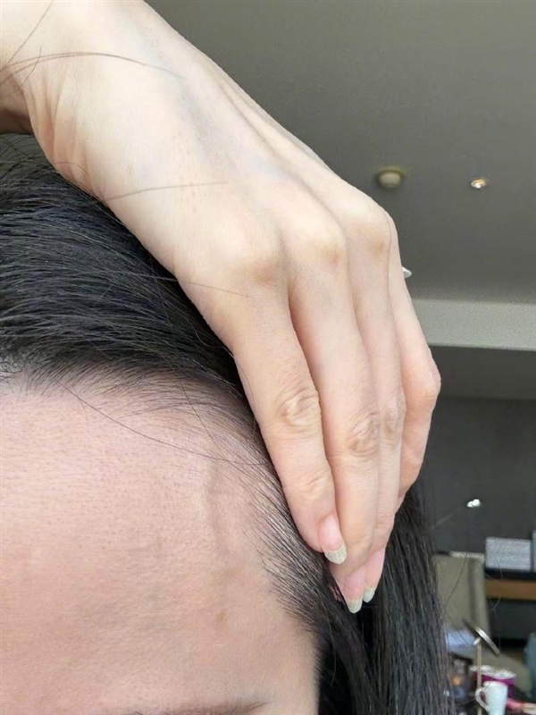 张靓颖自曝体检查出营养不良:额头血管莫名突起 伸懒腰手掌就流血