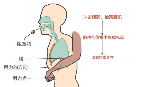 海姆立克急救法更新了：先拍5次背 再做“剪刀石头布”