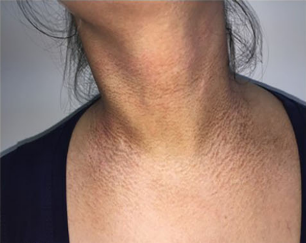 脖子总是黑黑的洗不干净？别大意 这可能是身体在求救