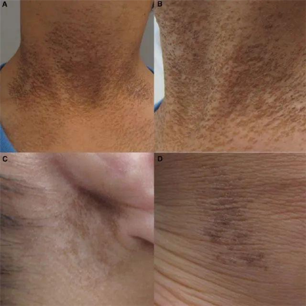 脖子总是黑黑的洗不干净？别大意 这可能是身体在求救