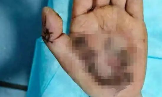 高压塔下方洗手被电击 男子险遭截肢